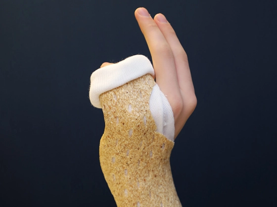 Woodcast Splint 4 mm - Stabile Frakturversorgung, ideal für Kinder - da hohe Belastbarkeit