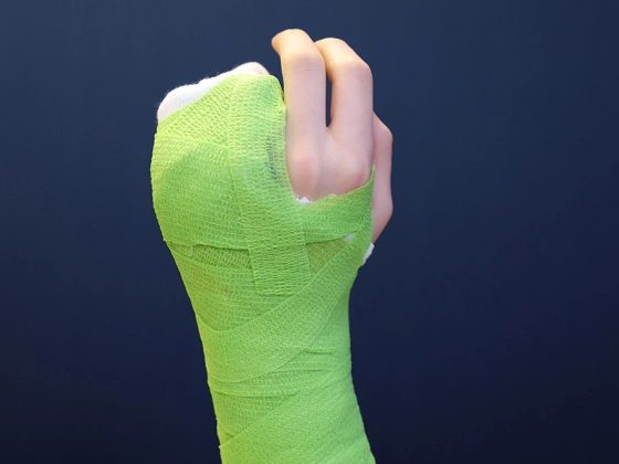 Woodcast Splint 4 mm - Stabile Frakturversorgung, ideal für Kinder - da hohe Belastbarkeit